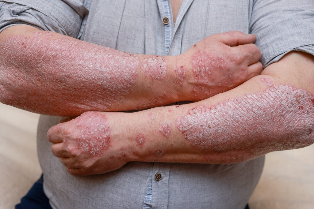 Psoriasis skin with red wounds. Male arms with cracked, hard, horny, flaky skin. Dermatological