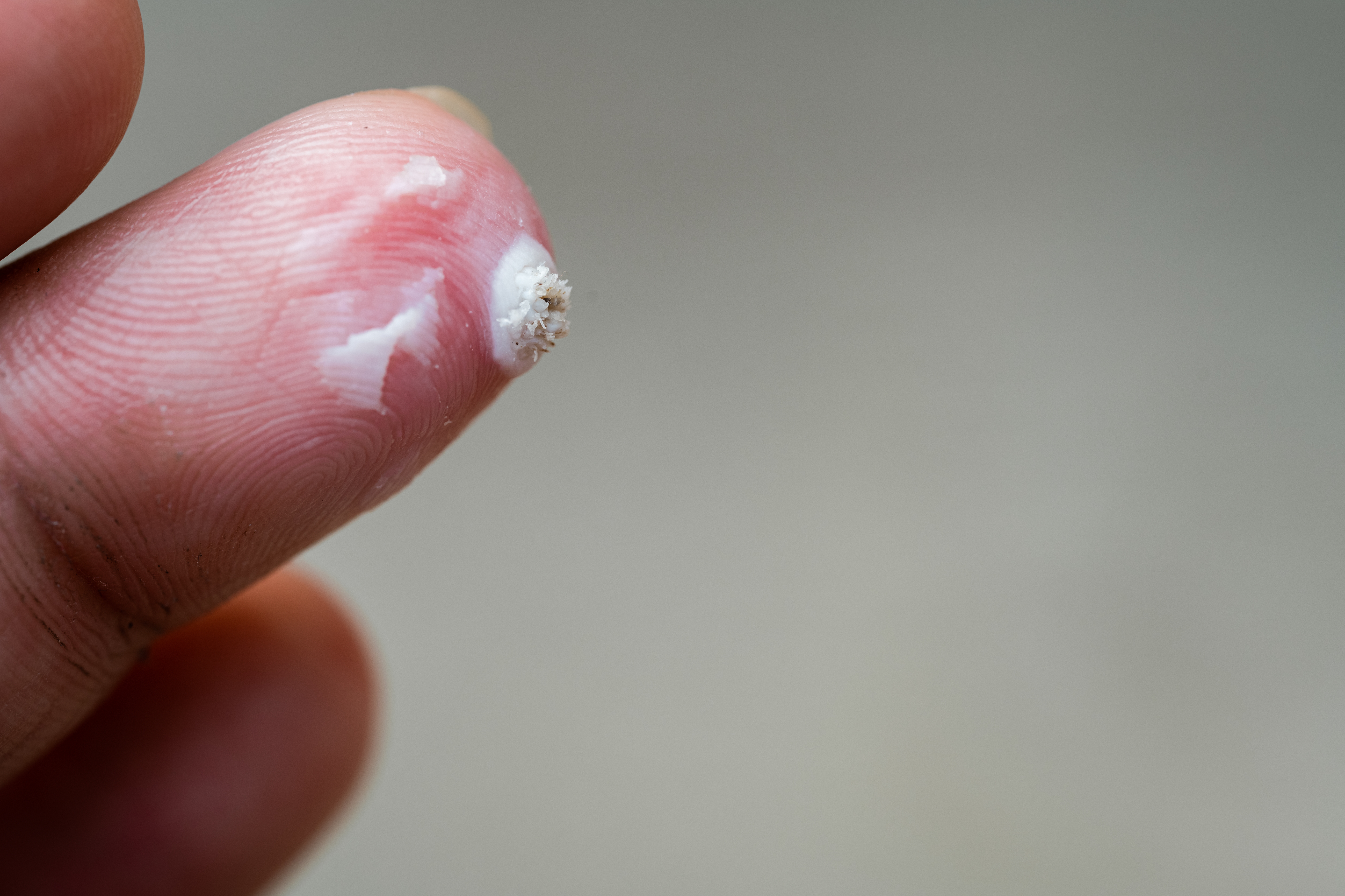 White warts on fingertips, skin disease being treated.