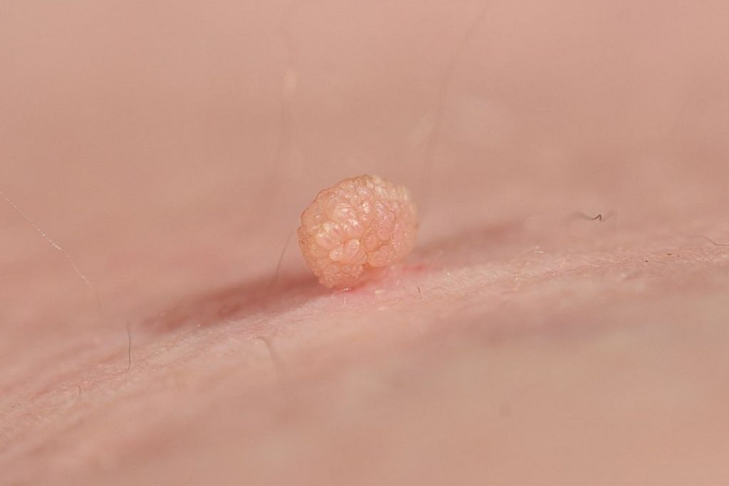 Skin tags: causes, symptoms, and removal - clearskin