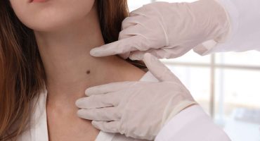 Does Insurance Cover Skin Tag Removal? - Acworth Dermatology