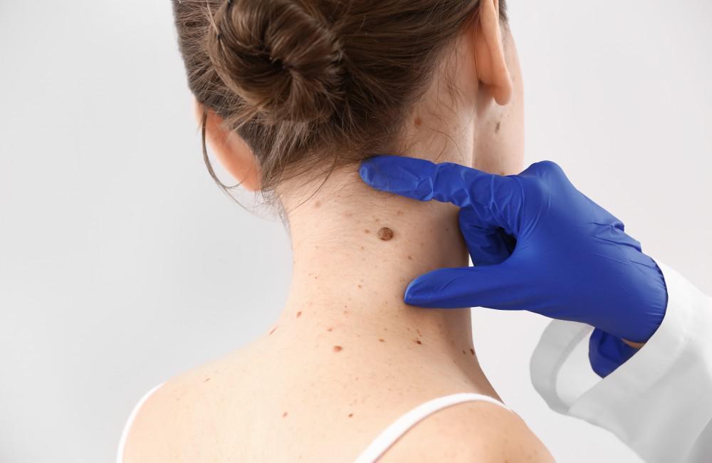 When to Have a Skin Tag Removed: Balcones Dermatology & Aesthetics:  Dermatologists