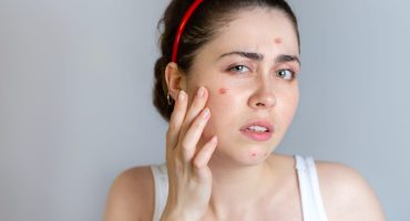 Young cute brunette woman examines her face with pimples. The concept of cosmetology and acne control, adolescence. Copy space