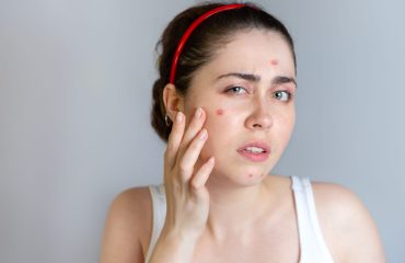 Young cute brunette woman examines her face with pimples. The concept of cosmetology and acne control, adolescence. Copy space
